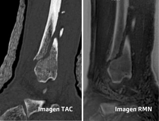 Fractura oblicua de peroné infrasindesmal Cortes coronales, sagitales y axiales. (1)