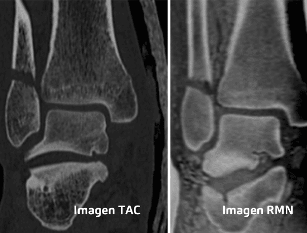Fractura oblicua de peroné infrasindesmal Cortes coronales, sagitales y axiales. (3)