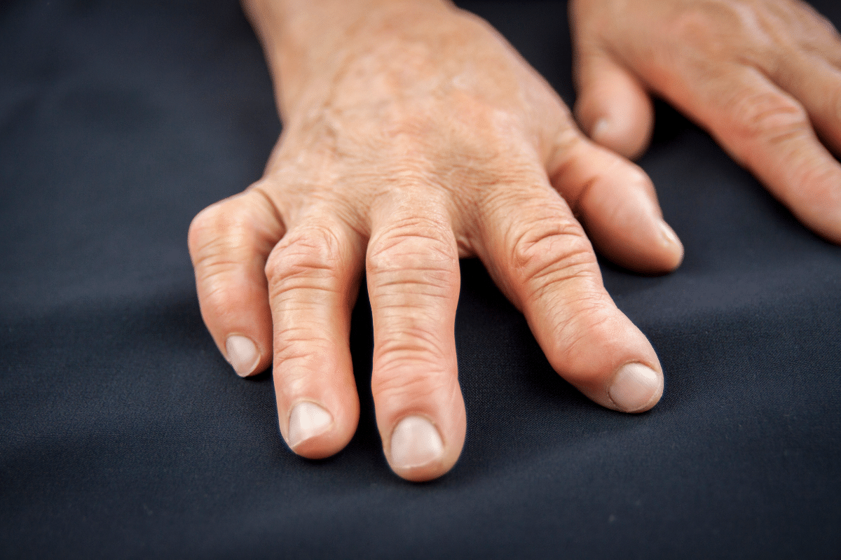 artritis-reumatoide-que-es-id-87