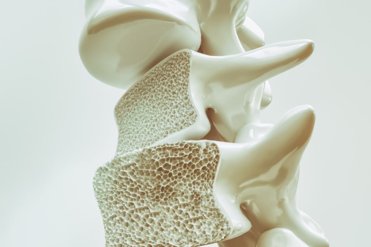 el-diagnostico-precoz-de-la-osteoporosis-mediante-densitometria-osea-id-75