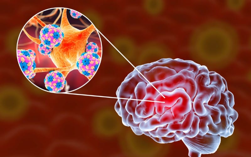 meningitis-que-es-como-detectarla-y-cuales-son-sus-sintomas-id-73